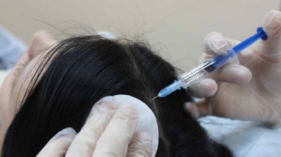 Инъекционная озонотерапия для волос