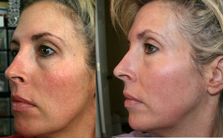 Фото до и после лазерной шлифовки лица